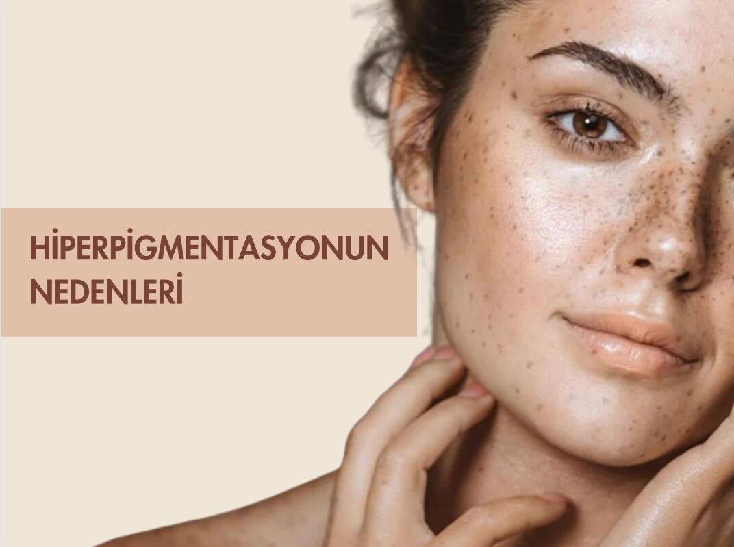 leke, hiperpigmentasyon, inflamaging, foto-yaşlanma, melasma, güneş