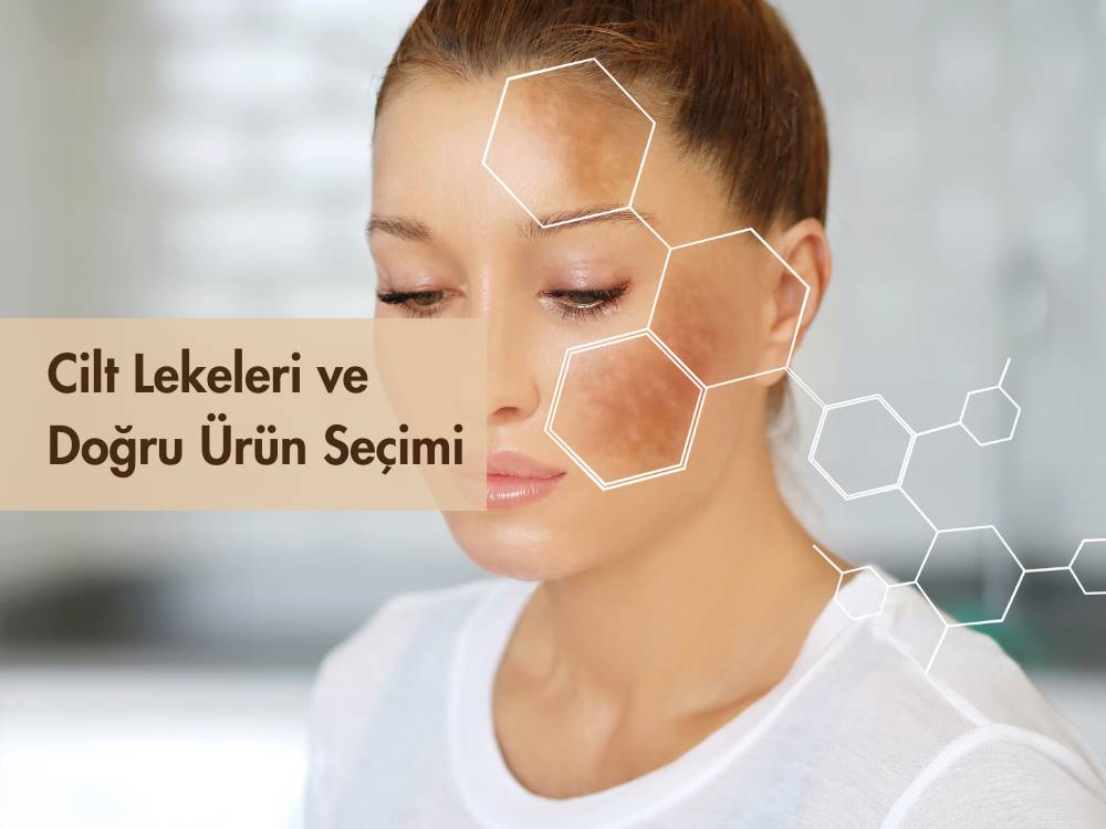 leke, leke tedavisi, leke çözümleri, hiperpigmentasyon, leke sebepleri